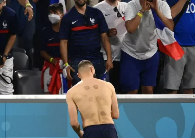 ventouses Karim Benzema